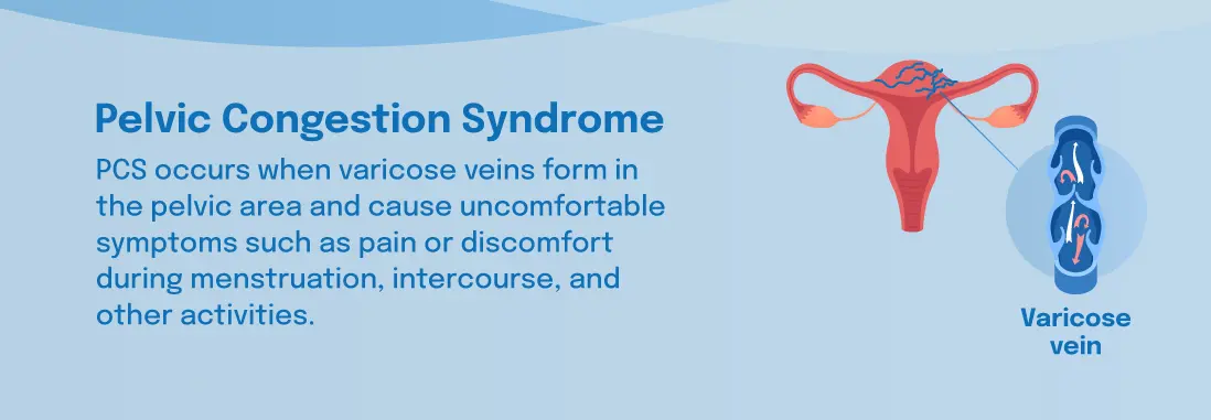 Pelvic Congestion Syndrome  What Is Pelvic Congestion Syndrome?